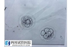 做試管嬰兒一次移植多個襄胚有好處嗎？